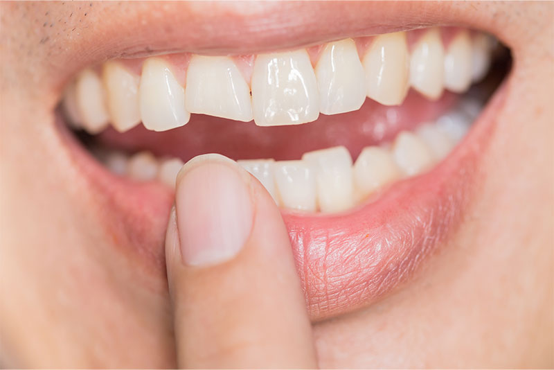 Broken Tooth