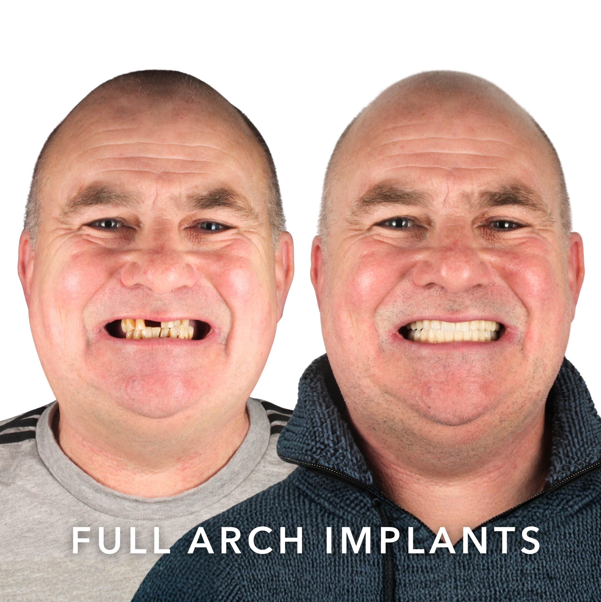 Before and after — Full Arch Implants