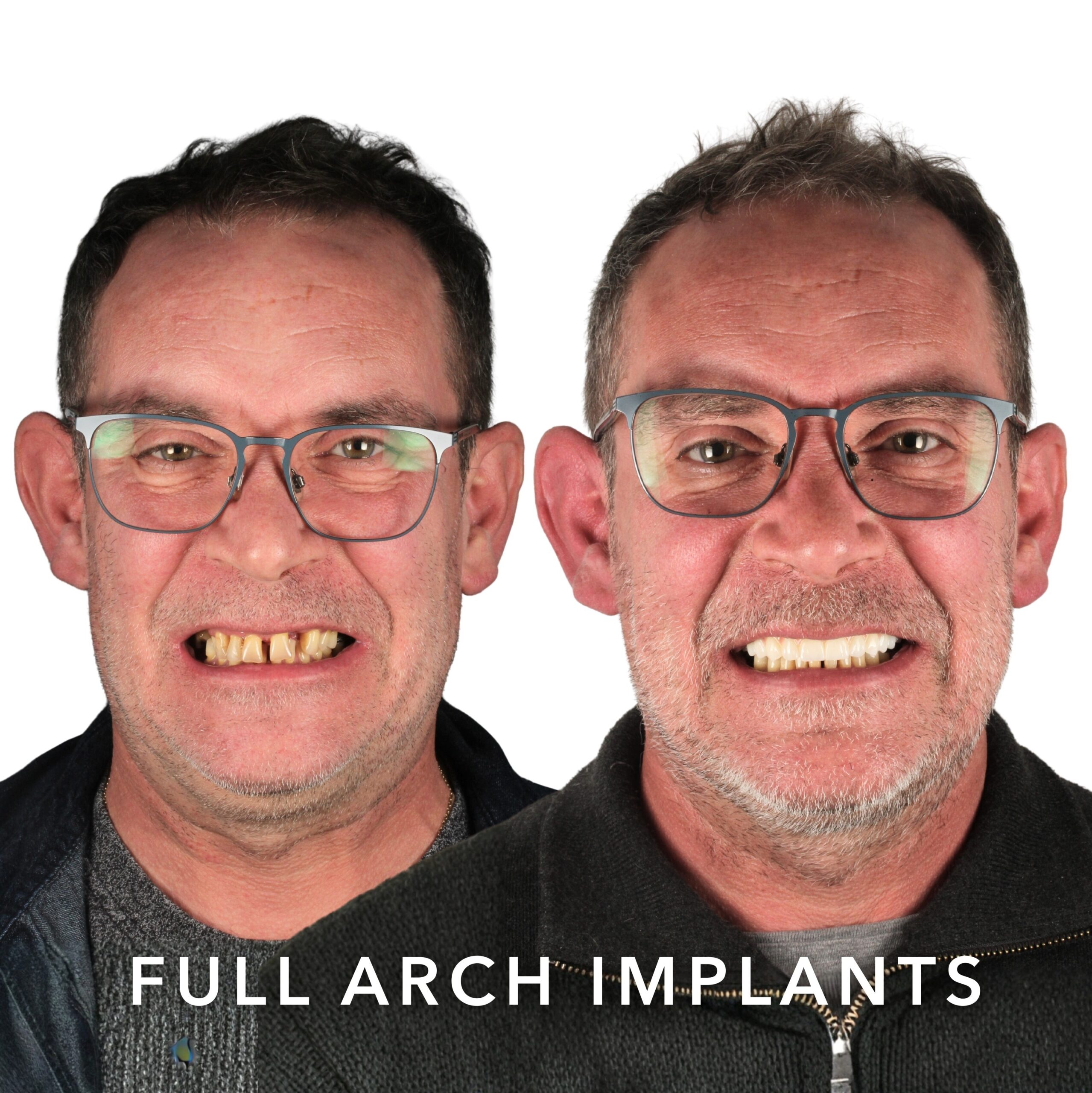 Before and after — Full Arch Implants
