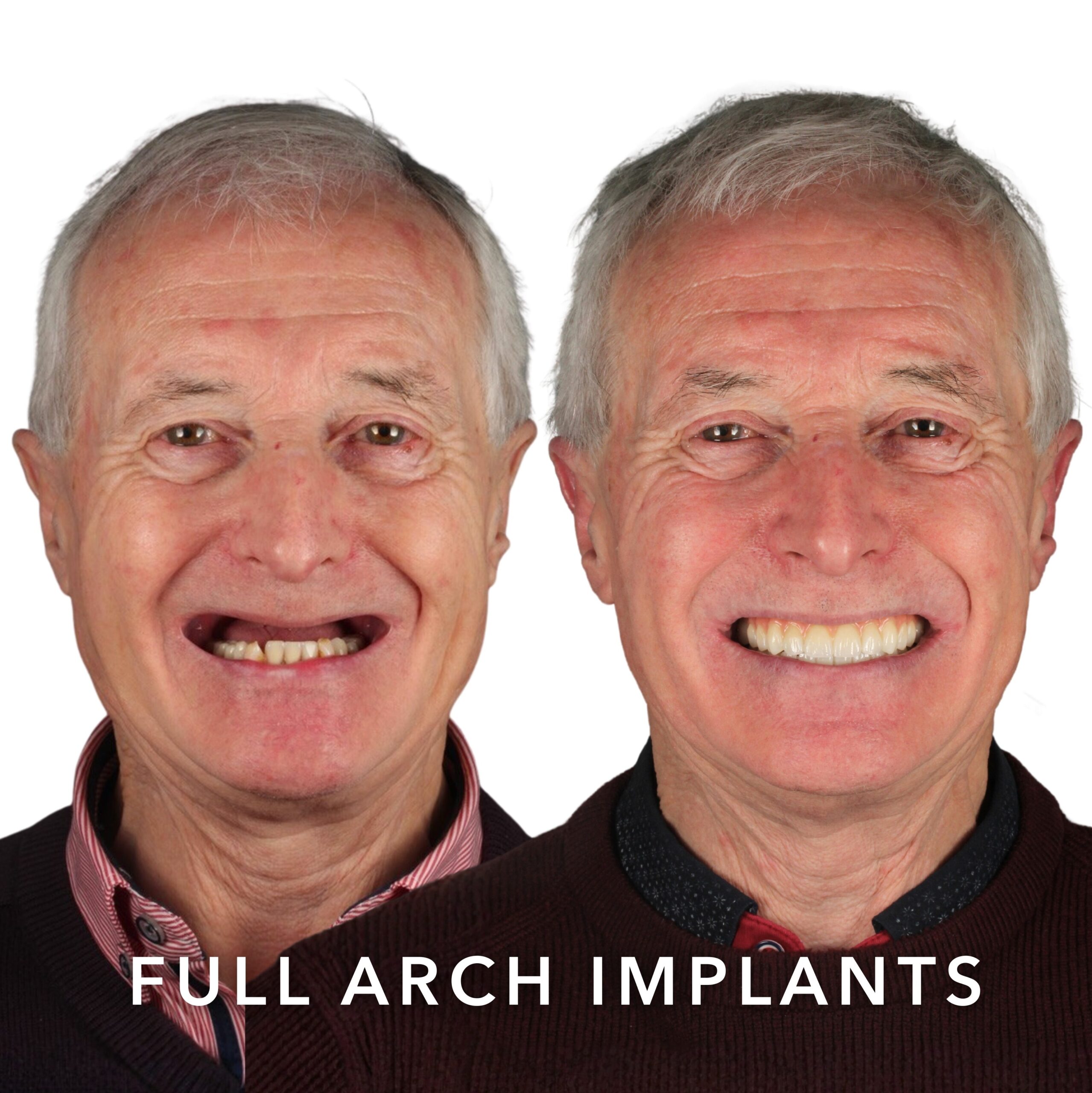 Before and after — Full Arch Implants
