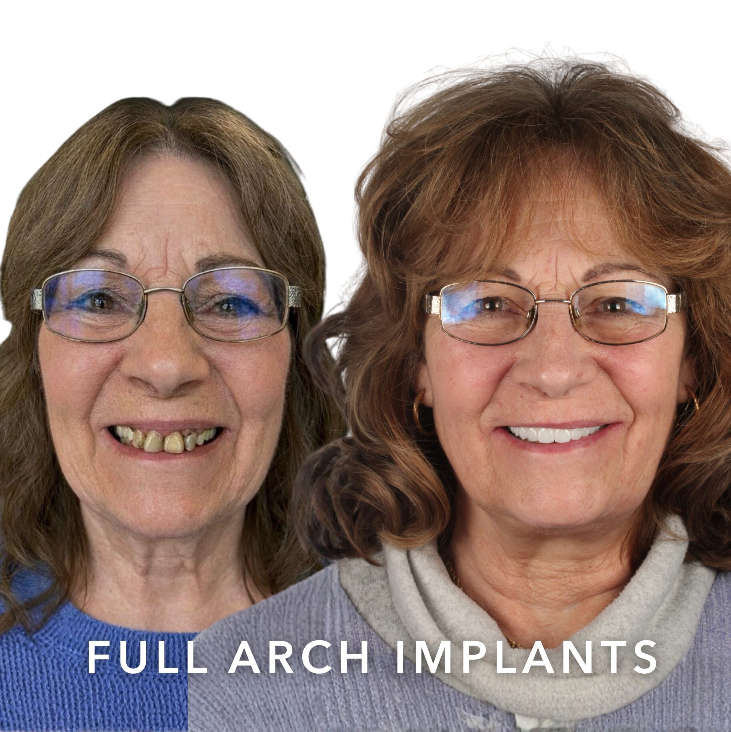 Before and after — Full Arch Implants