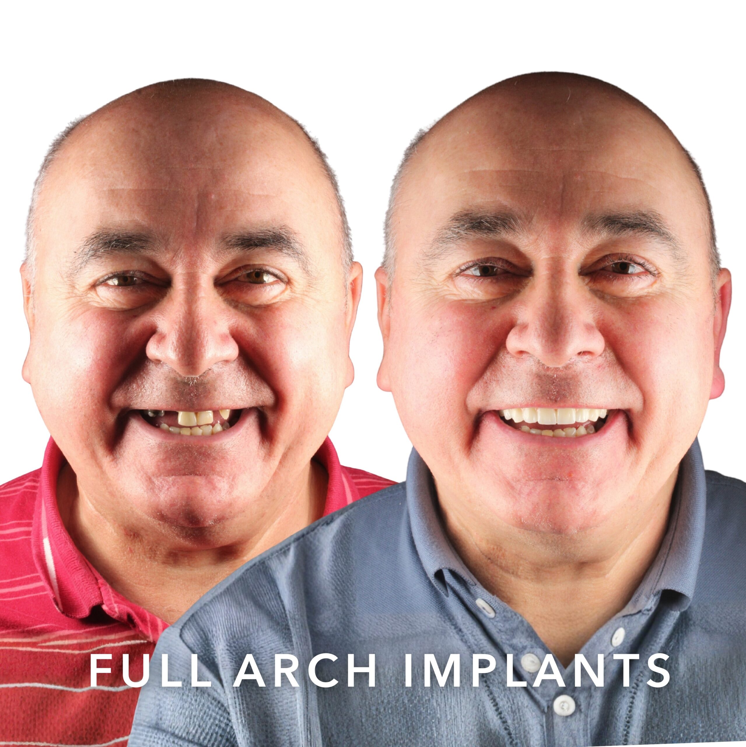 Before and after — Full Arch Implants