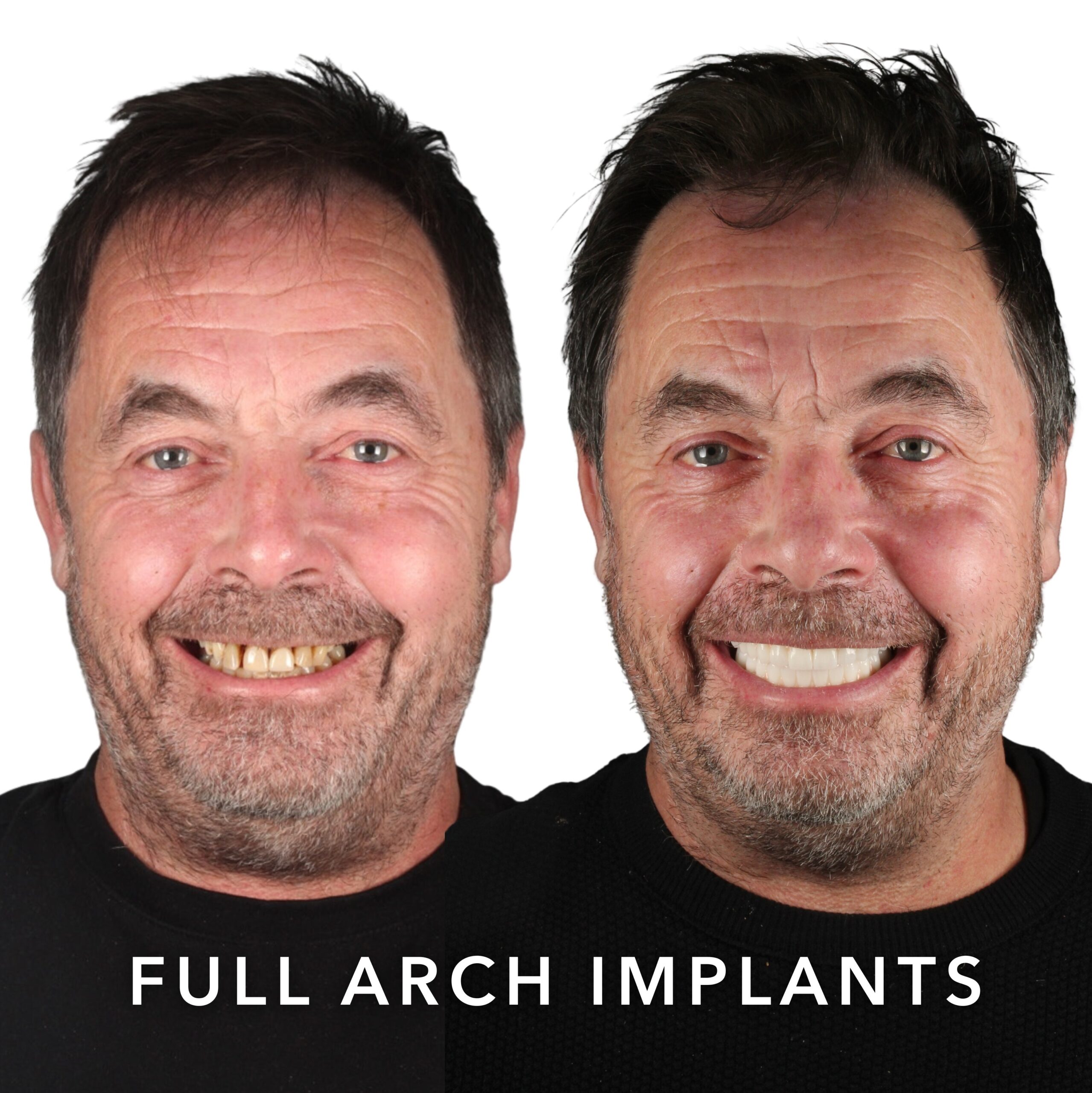 Before and after — Full Arch Implants