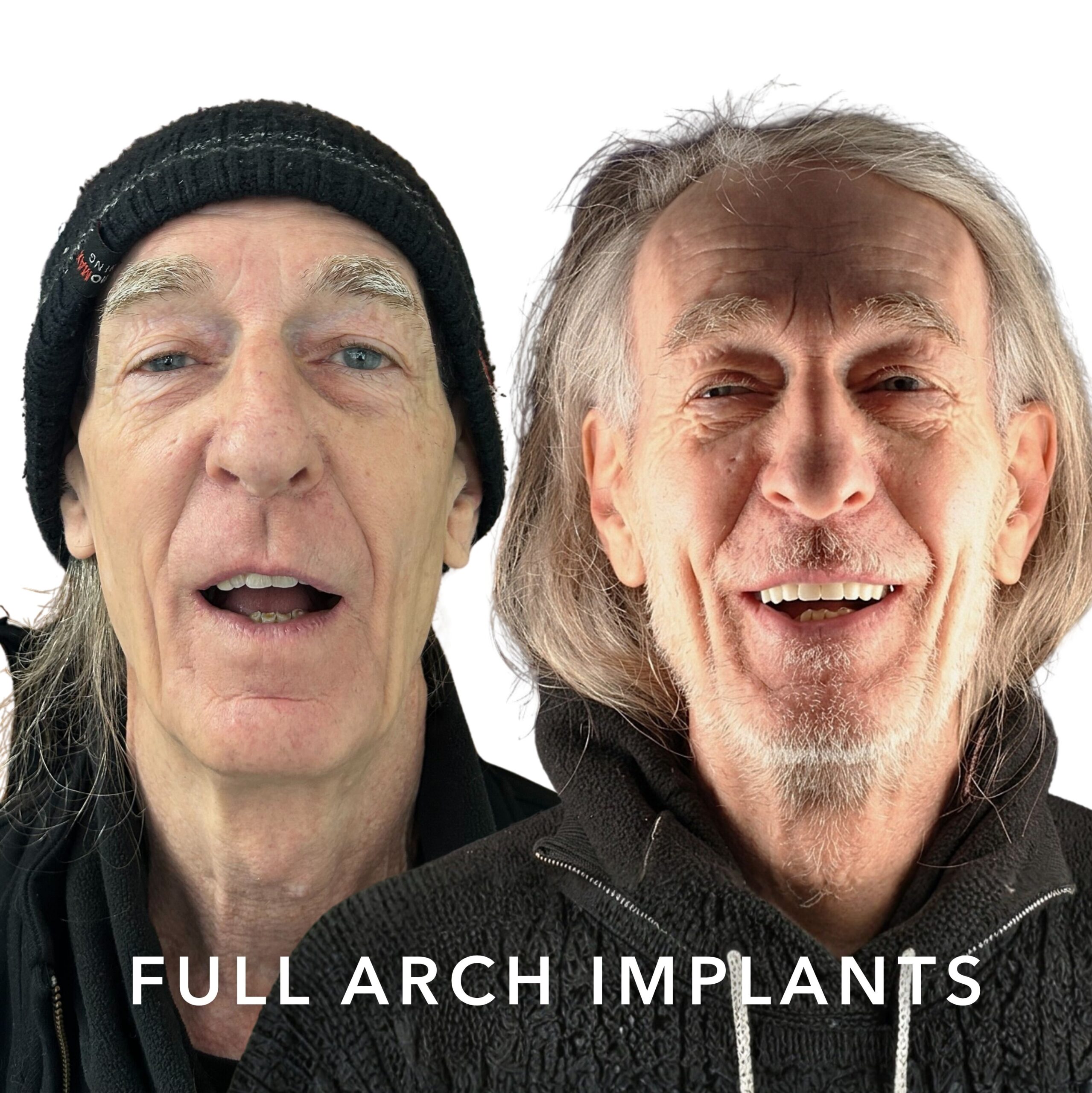 Before and after — Full Arch Implants
