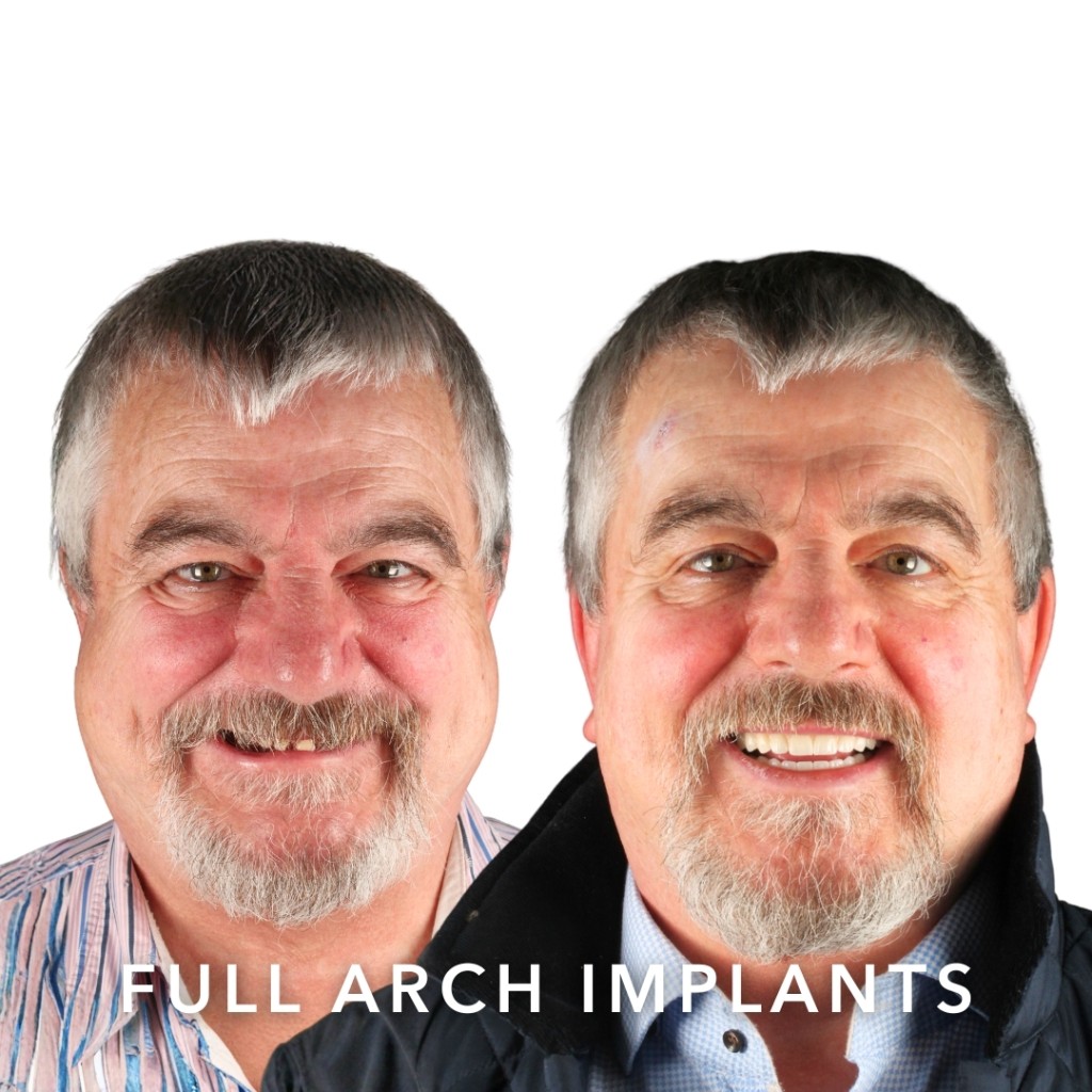 Before and after — Full Arch Implants