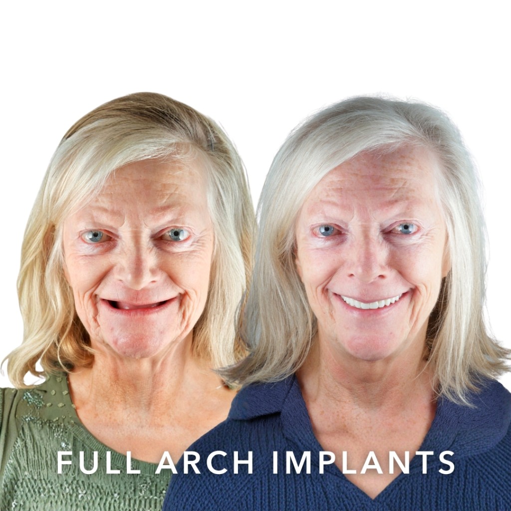Before and after — Full Arch Implants