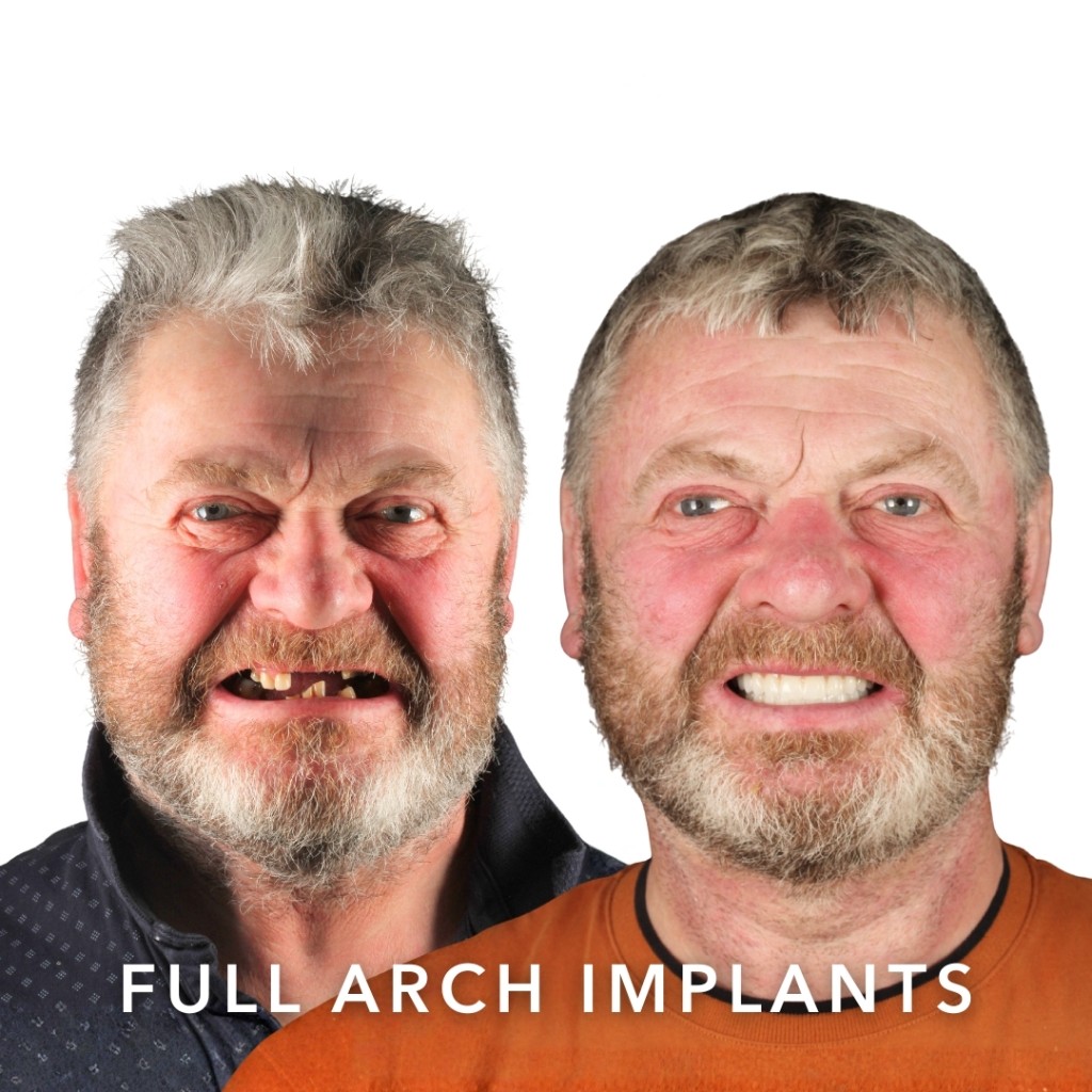 Before and after — Full Arch Implants