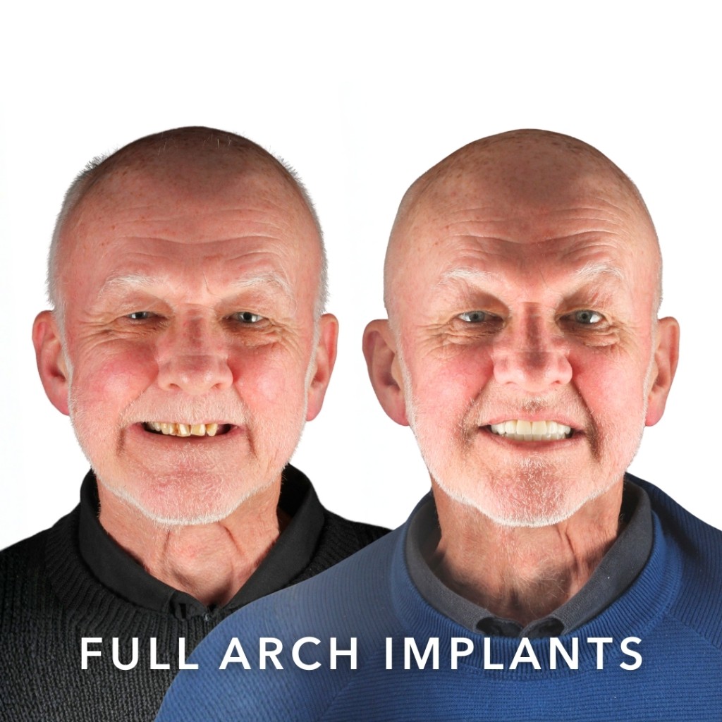 Before and after — Full Arch Implants