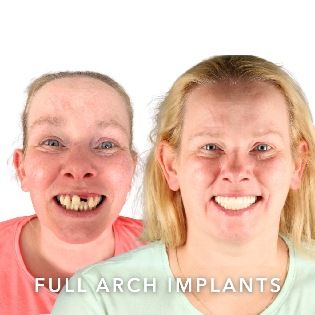 Before and after — Full Arch Implants