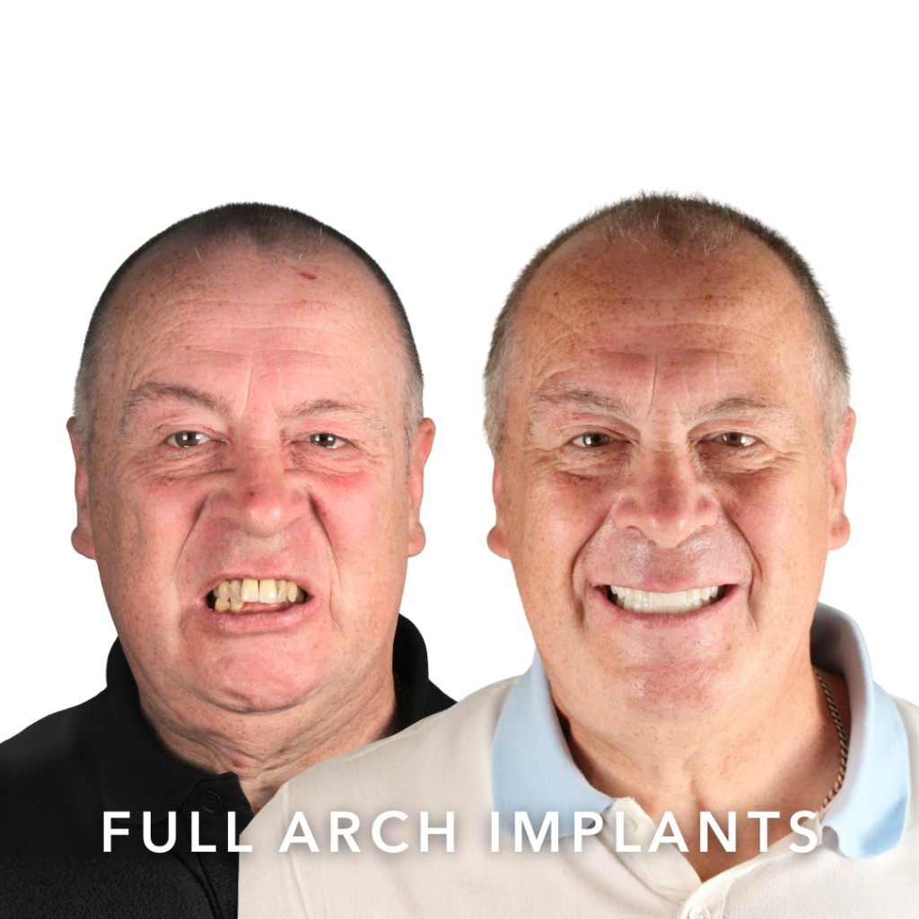 Before and after full arch dental implants — Damien | Slievemore Dental, Dublin