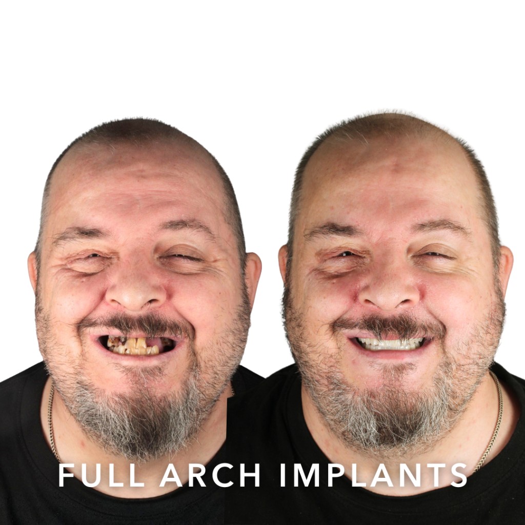 Before and after full arch dental implants — Eddie | Slievemore Dental, Dublin