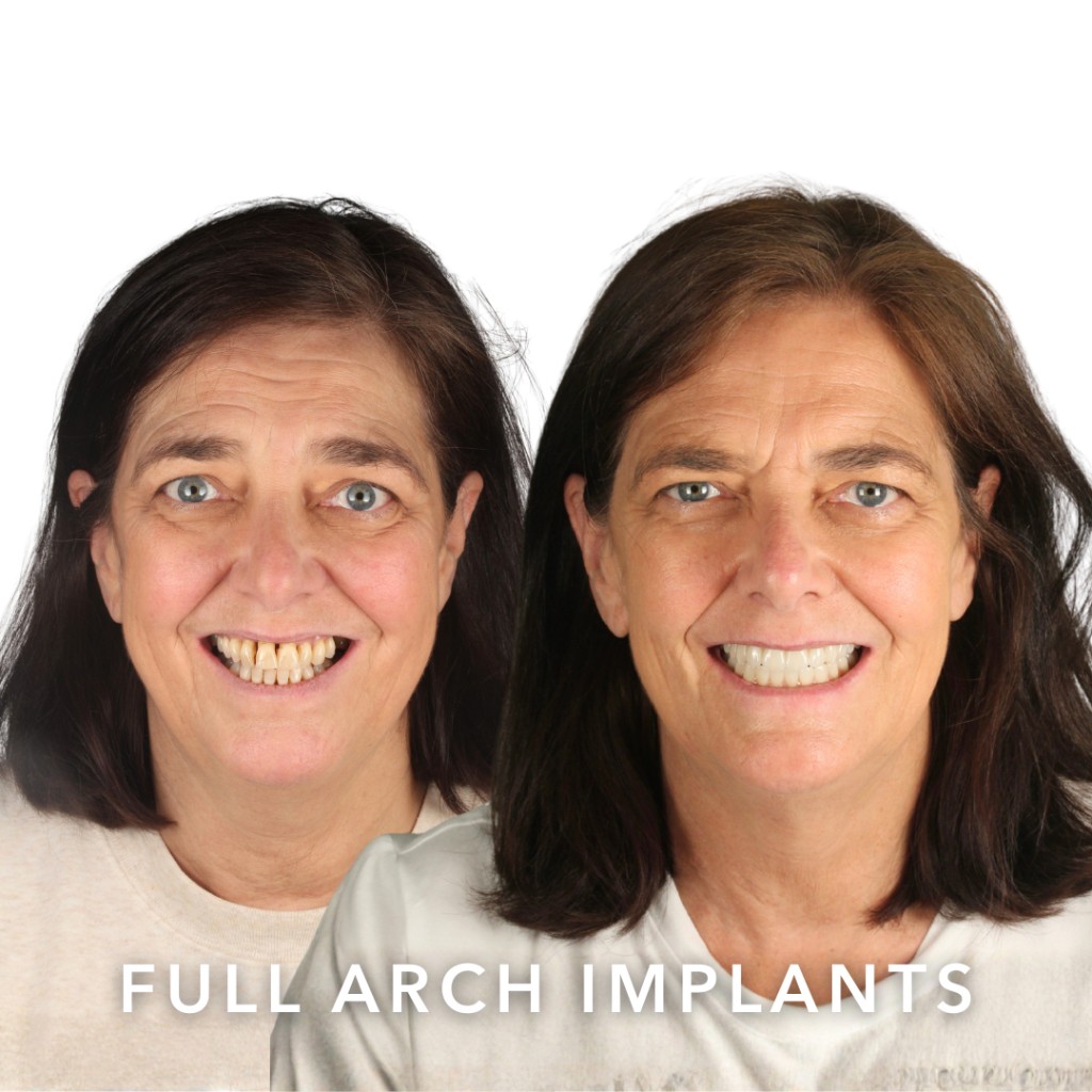 Before and after full arch dental implants — Emily | Slievemore Dental, Dublin