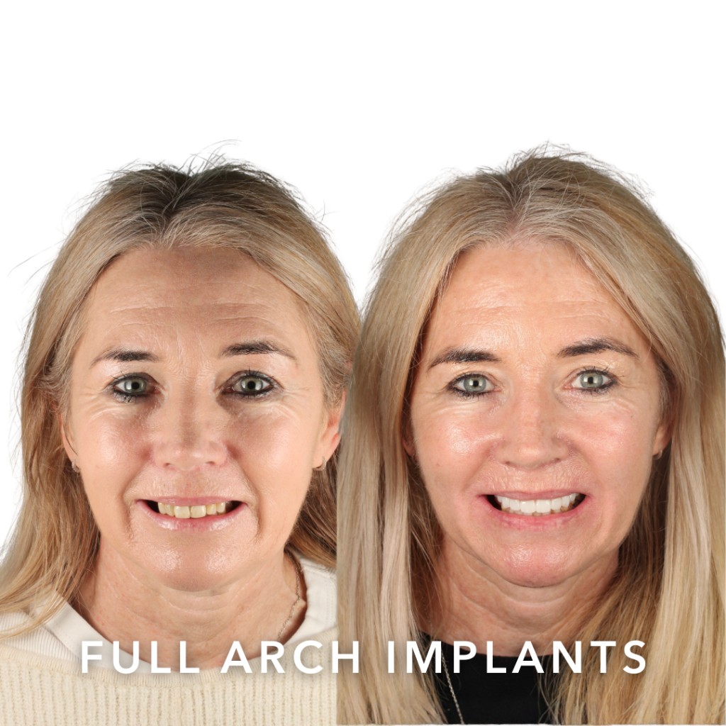Before and after full arch dental implants — Lesley | Slievemore Dental, Dublin