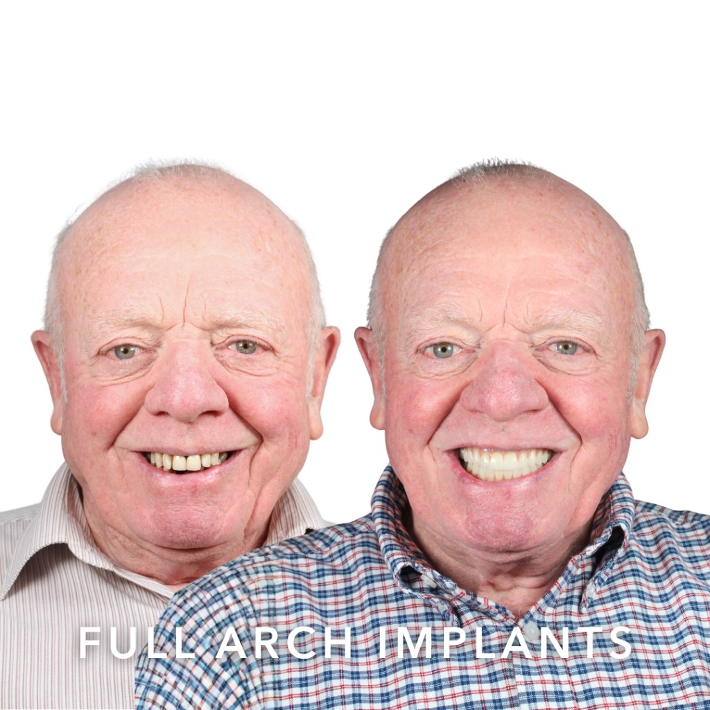Before and after full arch dental implants — Michael | Slievemore Dental, Dublin