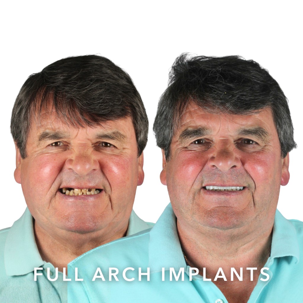 Before and after full arch dental implants — Noel D. | Slievemore Dental, Dublin