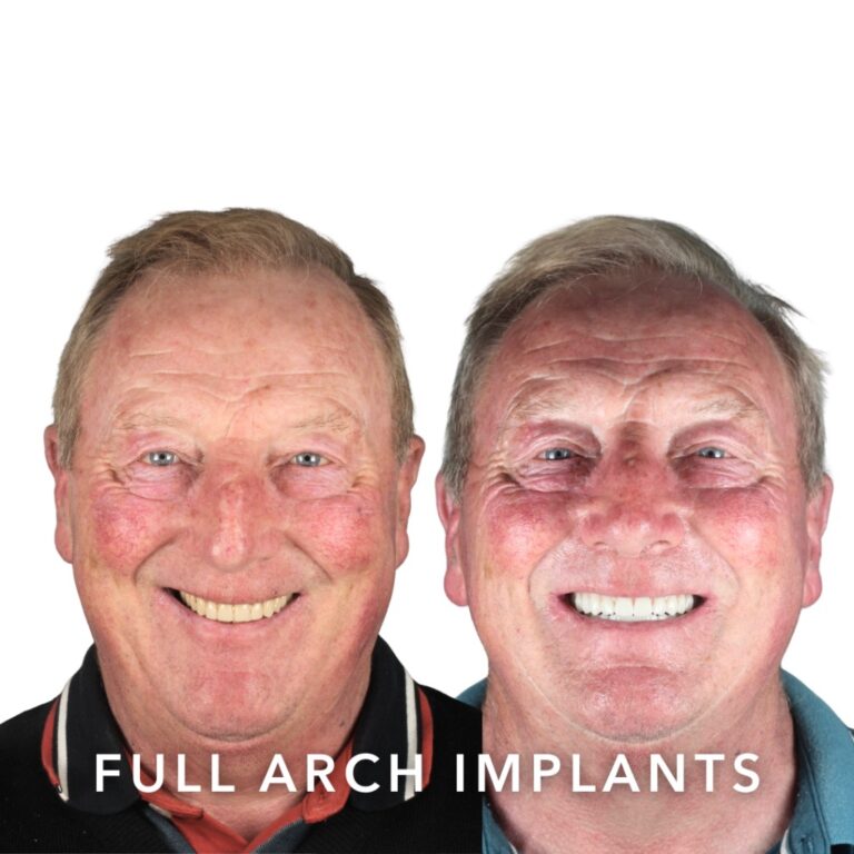 Before and after full arch dental implants – Noel, Slievemore Dental, Stillorgan