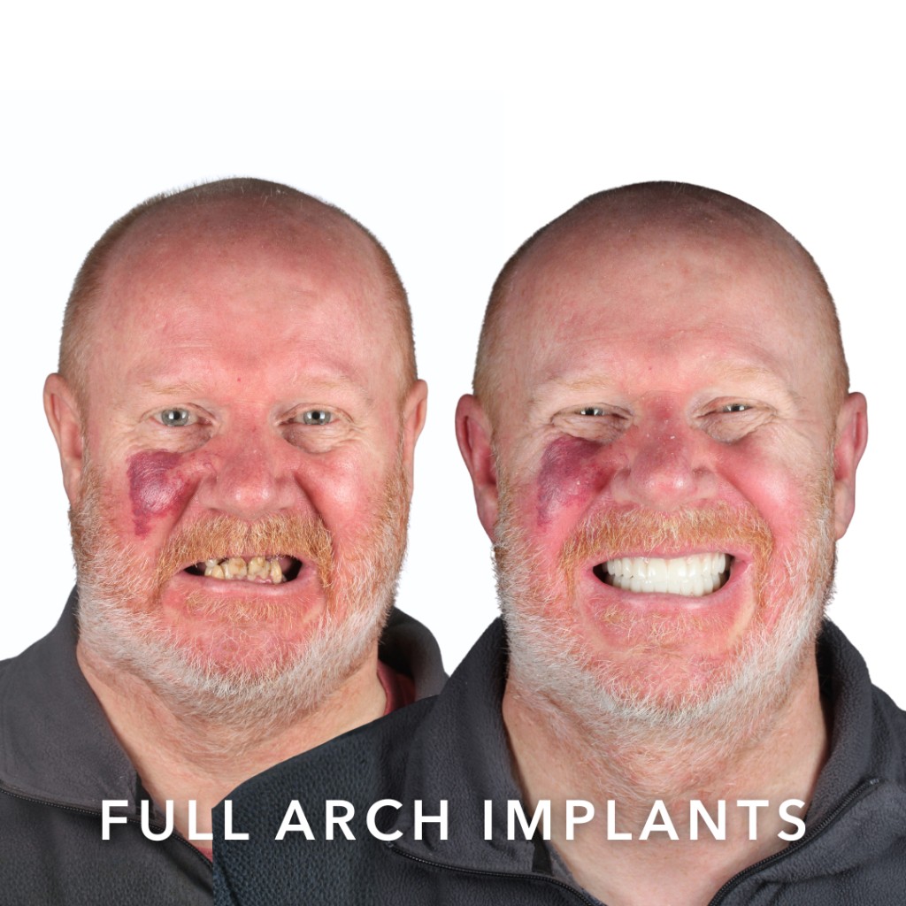 Before and after full arch dental implants — Paul | Slievemore Dental, Dublin