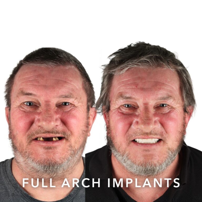 Before and after full arch dental implants – George, Slievemore Dental, Stillorgan