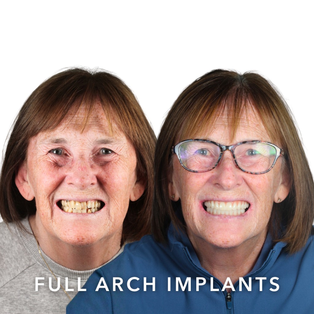 Before and after full arch dental implants — Joan | Slievemore Dental, Dublin