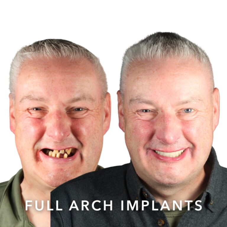Before and after full arch dental implants – Robert, Slievemore Dental, Stillorgan