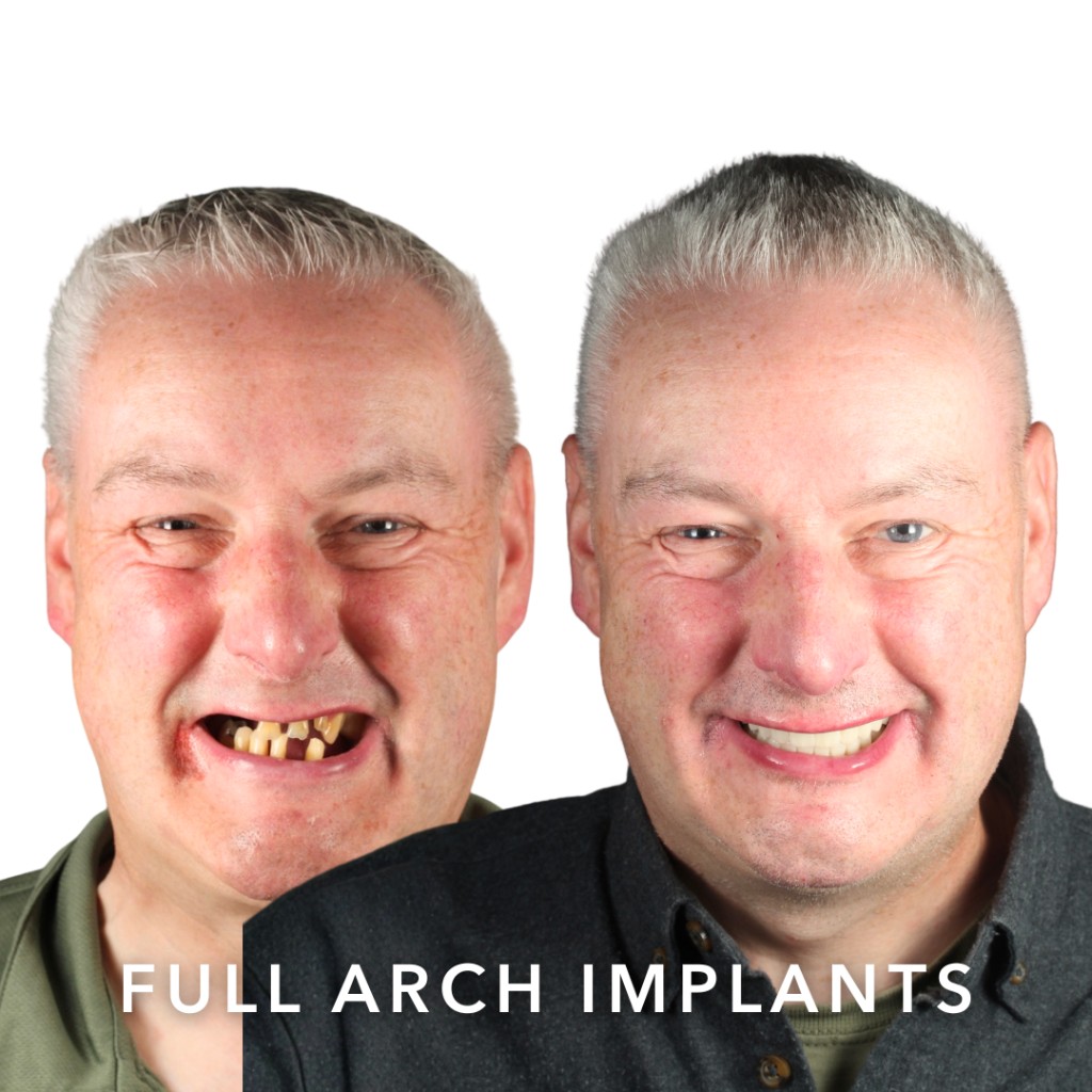 Before and after full arch dental implants — Robert | Slievemore Dental, Dublin